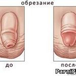 Ученые установили, что обрезание снижает риск заразиться ВИЧ на 60%